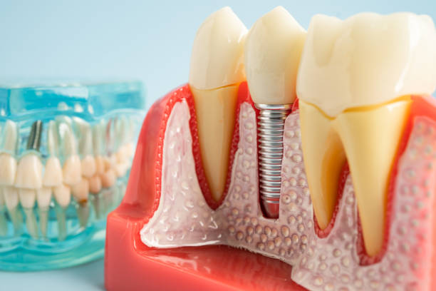 Best Tooth Extraction  in Mcchord Af, WA